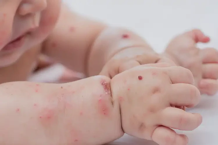 嬰兒四肢起濕疹不管它會(huì)自己好嗎(圖4)