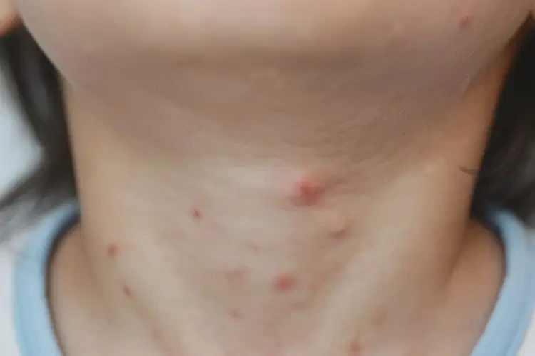 儿童脖子偶尔起湿疹不管它会自己自愈吗(图4)