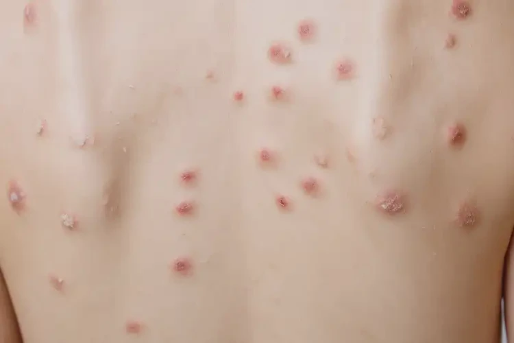 女性全身出現(xiàn)濕疹可以徹底自愈嗎(圖4)