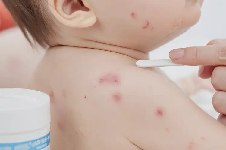 嬰兒脖子上出現(xiàn)濕疹可以徹底自愈嗎(圖4)