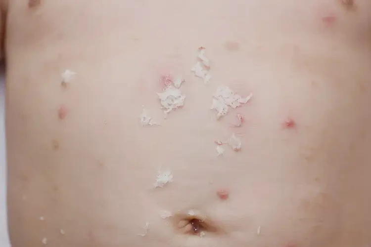 小兒肚子上容易起濕疹不管它會自己自愈嗎(圖3)