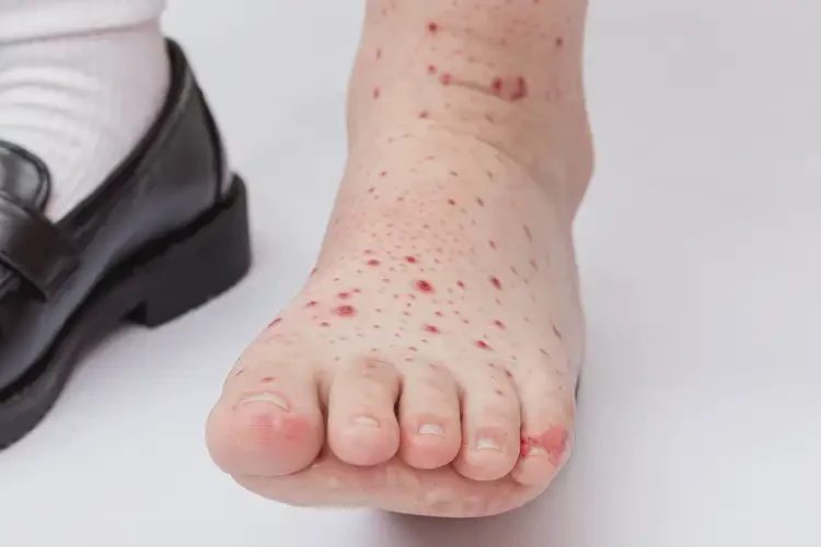 小學生腳上出濕疹能夠徹底治愈嗎(圖4)