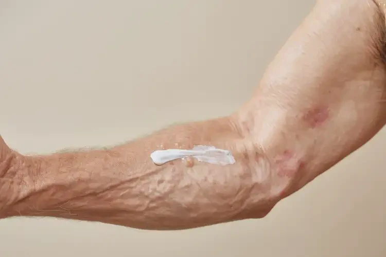 高齡老人手臂上經(jīng)常起濕疹可不可以徹底自愈(圖3)