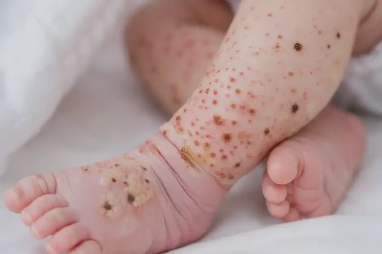 新生兒小腿上偶爾起濕疹不管它會自己自愈嗎(圖3)