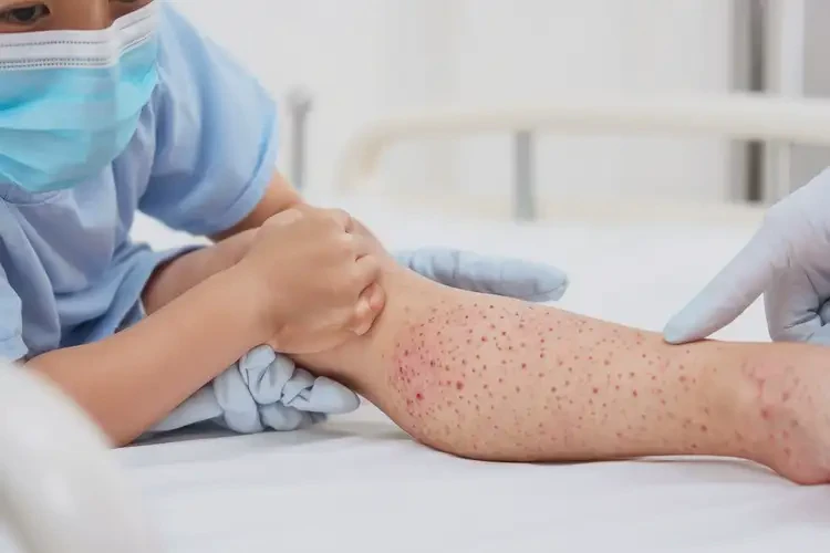 幼兒四肢容易起濕疹可不可以徹底自愈(圖4)