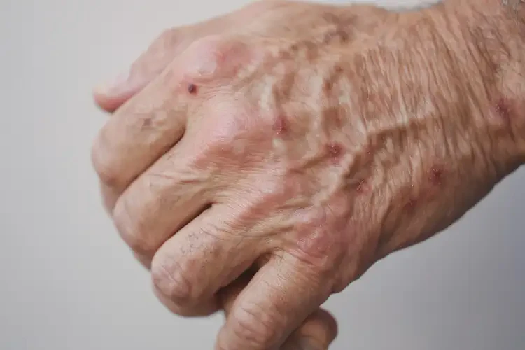 老年人手上偶爾起濕疹不管它會自己痊愈嗎(圖4)