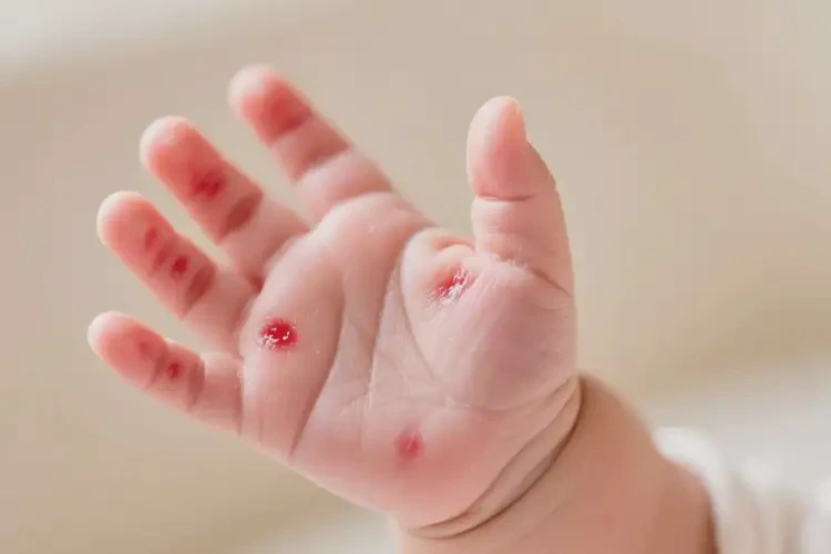 嬰幼兒手上經(jīng)常長(zhǎng)濕疹不管它會(huì)自己痊愈嗎(圖3)