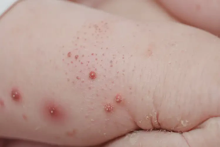 新生兒全身容易起濕疹能夠徹底治愈嗎(圖4)