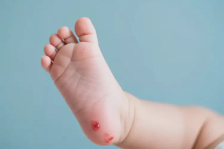 嬰兒腳上偶爾長濕疹不管它會(huì)自己好嗎(圖1)