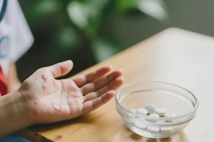 中學(xué)生手上偶爾長濕疹能夠徹底治愈嗎(圖3)