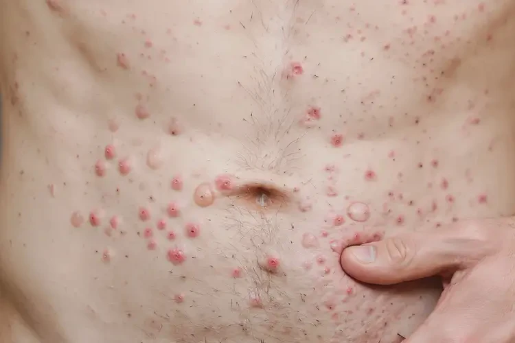 青年人肚子上長濕疹能不能徹底自愈(圖4)