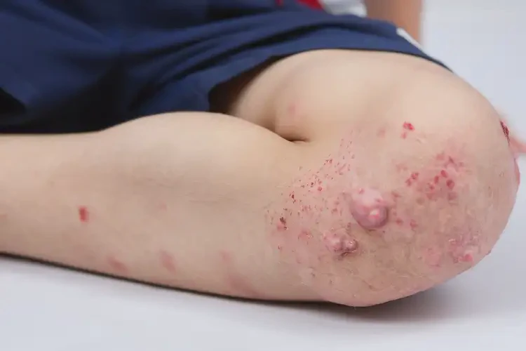 小學(xué)生大腿上出現(xiàn)濕疹可以徹底自愈嗎(圖4)