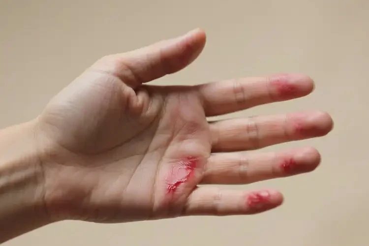 产妇手上偶尔长湿疹可不可以彻底自愈(图4)