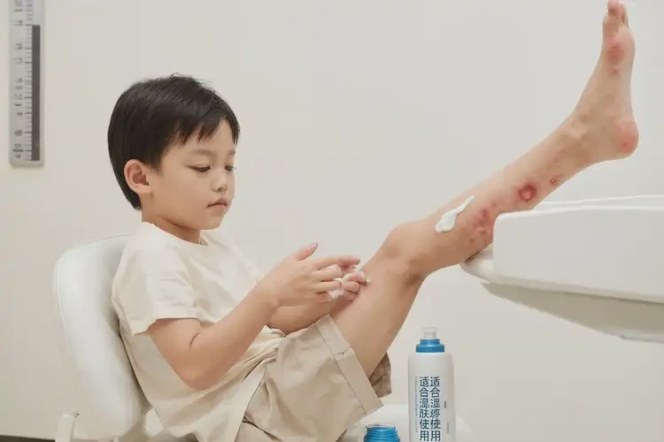 孩子腳上經(jīng)常長(zhǎng)濕疹能夠徹底治愈嗎(圖2)