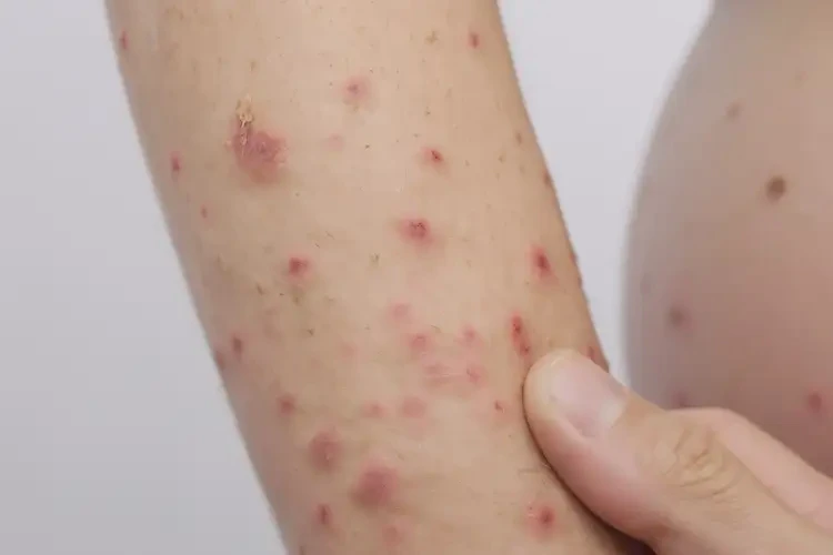 孕妇手臂上经常起湿疹可不可以彻底自愈(图4)