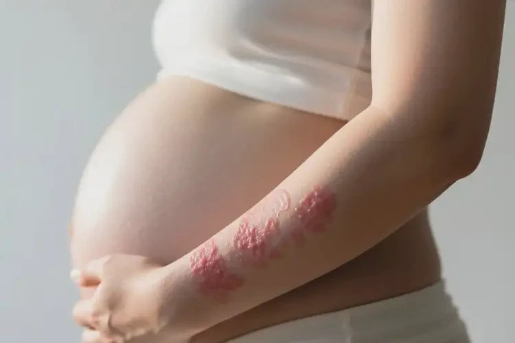 孕婦手臂出現(xiàn)濕疹可不可以徹底自愈(圖4)