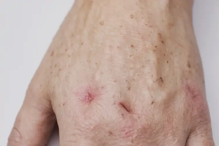 大學(xué)生手上偶爾起濕疹不管它會(huì)自己自愈嗎(圖4)