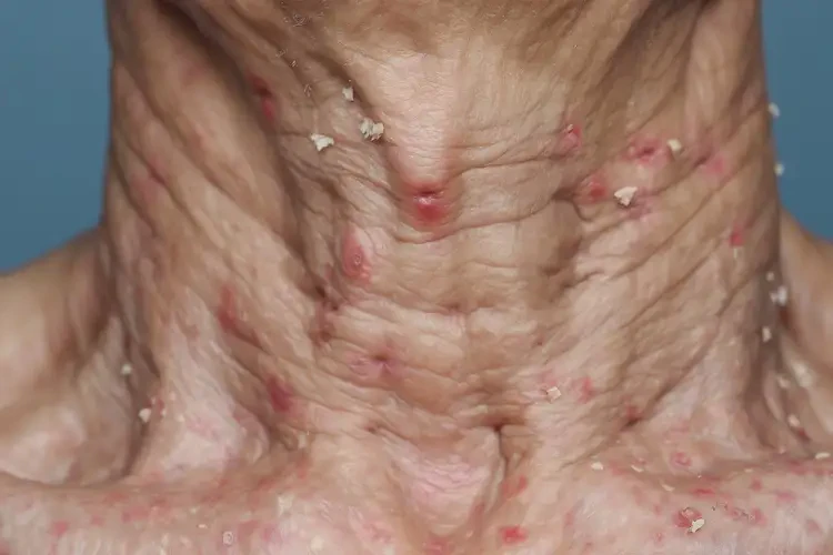 老年人脖子上有濕疹不管它會自己痊愈嗎(圖4)