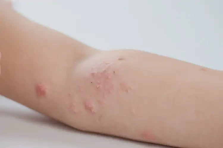 少兒身上出現(xiàn)濕疹不管它會(huì)自己自愈嗎(圖4)