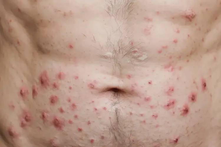 男性肚子容易起濕疹能靠自己自愈嗎(圖4)