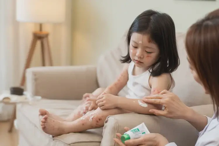 小孩四肢偶爾起濕疹可以徹底自愈嗎(圖3)