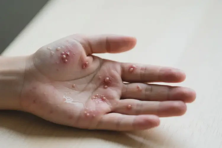 青少年手上有濕疹可不可以徹底自愈(圖4)