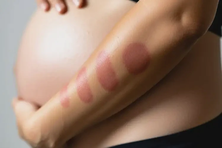 孕妇手臂上出湿疹不管它会自己自愈吗(图3)