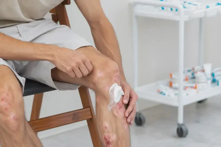 青年人小腿上出現(xiàn)濕疹可以徹底自愈嗎(圖2)