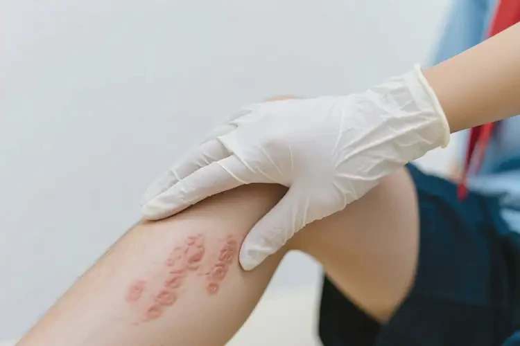 中學(xué)生大腿長濕疹能不能徹底自愈(圖1)