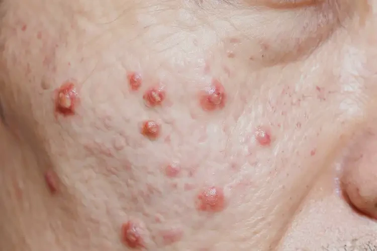 女生大腿上出現(xiàn)濕疹可以徹底自愈嗎(圖3)