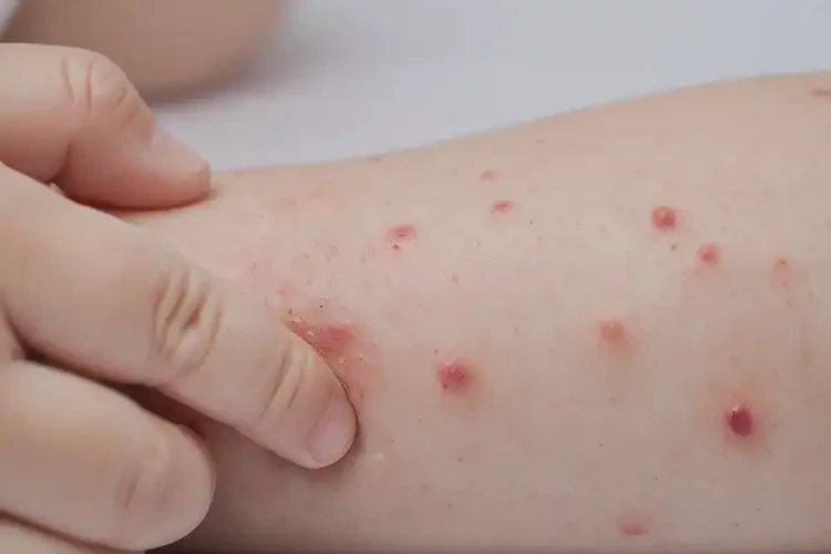 幼兒肛周出濕疹可以徹底自愈嗎(圖4)