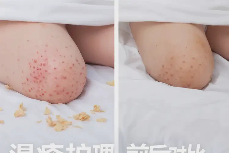 孩子屁股出濕疹不管它會自己好嗎(圖2)