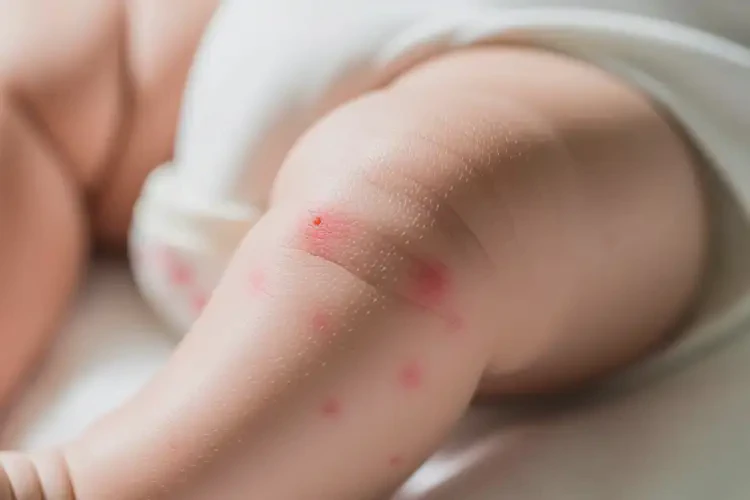 嬰兒大腿偶爾長(zhǎng)濕疹可以徹底自愈嗎(圖4)