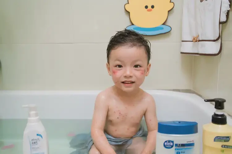 孩子全身長濕疹能靠自己自愈嗎(圖2)