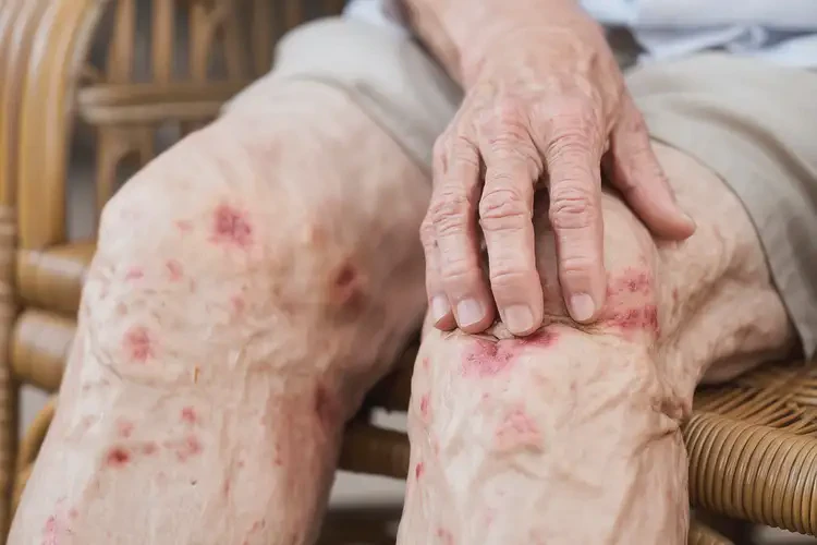 高齡老人大腿上經(jīng)常起濕疹可不可以徹底自愈(圖4)