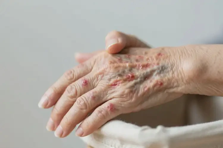高齡老人手上出濕疹能徹底自愈嗎(圖1)