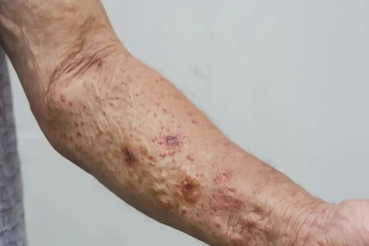 高龄老人手臂上经常长湿疹不管它会自己好吗(图4)