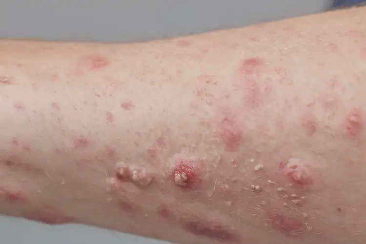 青少年手臂上出現(xiàn)濕疹不管它會自己痊愈嗎(圖3)