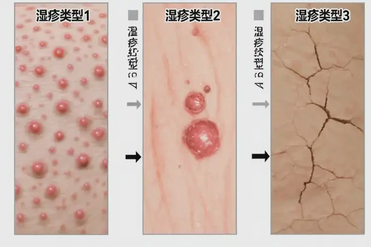 女生脖子起濕疹可以徹底自愈嗎(圖3)