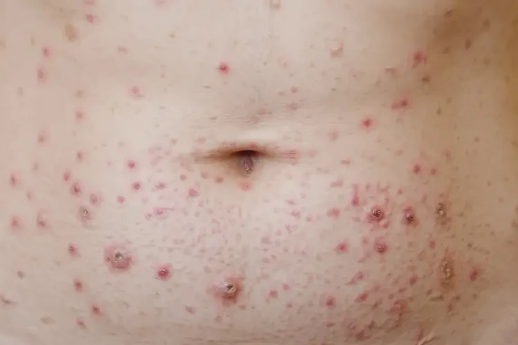 女人肚子上起濕疹可以徹底自愈嗎(圖4)