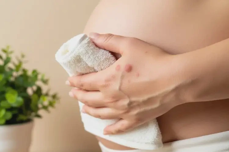 孕婦四肢長濕疹能徹底自愈嗎(圖4)