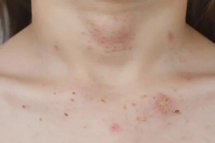 小學(xué)生脖子偶爾起濕疹能徹底自愈嗎(圖4)