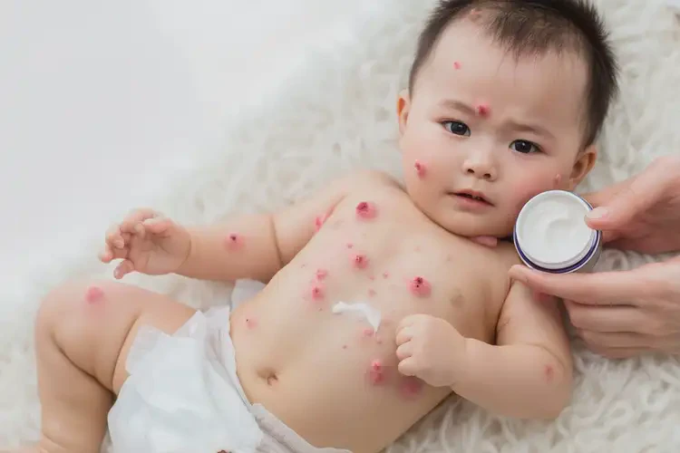 婴儿四肢偶尔长湿疹能靠自己自愈吗(图2)