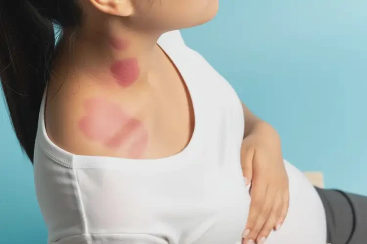 孕婦脖子上有濕疹不管它會自己自愈嗎(圖2)