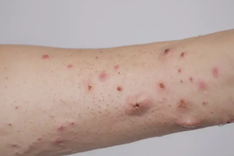 女人手臂上起湿疹不管它会自己好吗(图4)