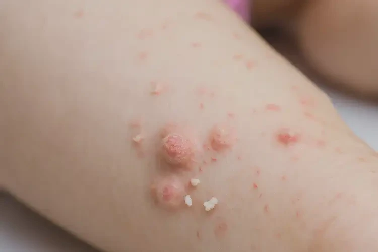 孩子小腿偶尔起湿疹可以彻底自愈吗(图3)