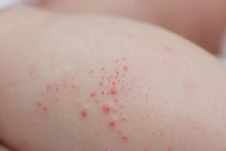 新生兒四肢容易長濕疹能夠徹底治愈嗎(圖4)