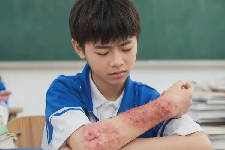 中學(xué)生全身偶爾起濕疹不管它會自己自愈嗎(圖4)