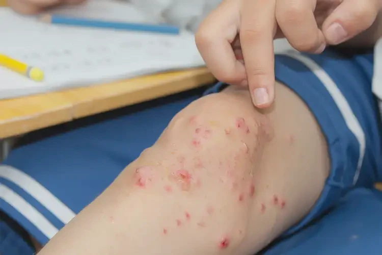 小學(xué)生小腿長濕疹不管它會自己自愈嗎(圖3)