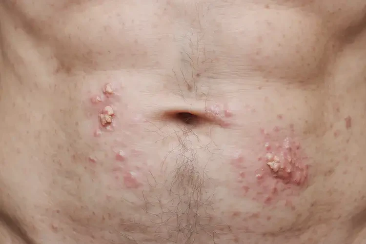 男人肚子偶爾起濕疹能夠徹底治愈嗎(圖4)